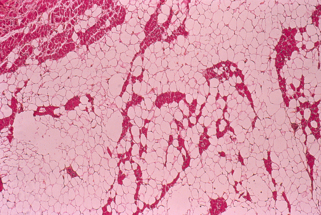 Lipoma tumour,light micrograph