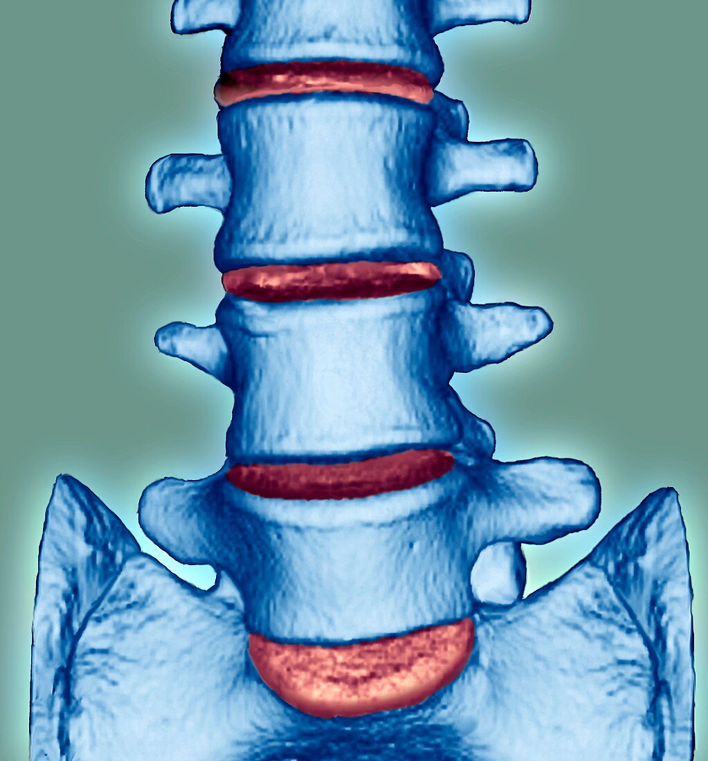 Spine disorder