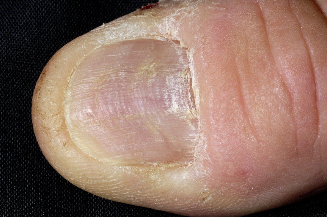 Thumbnail with lichen planus disease