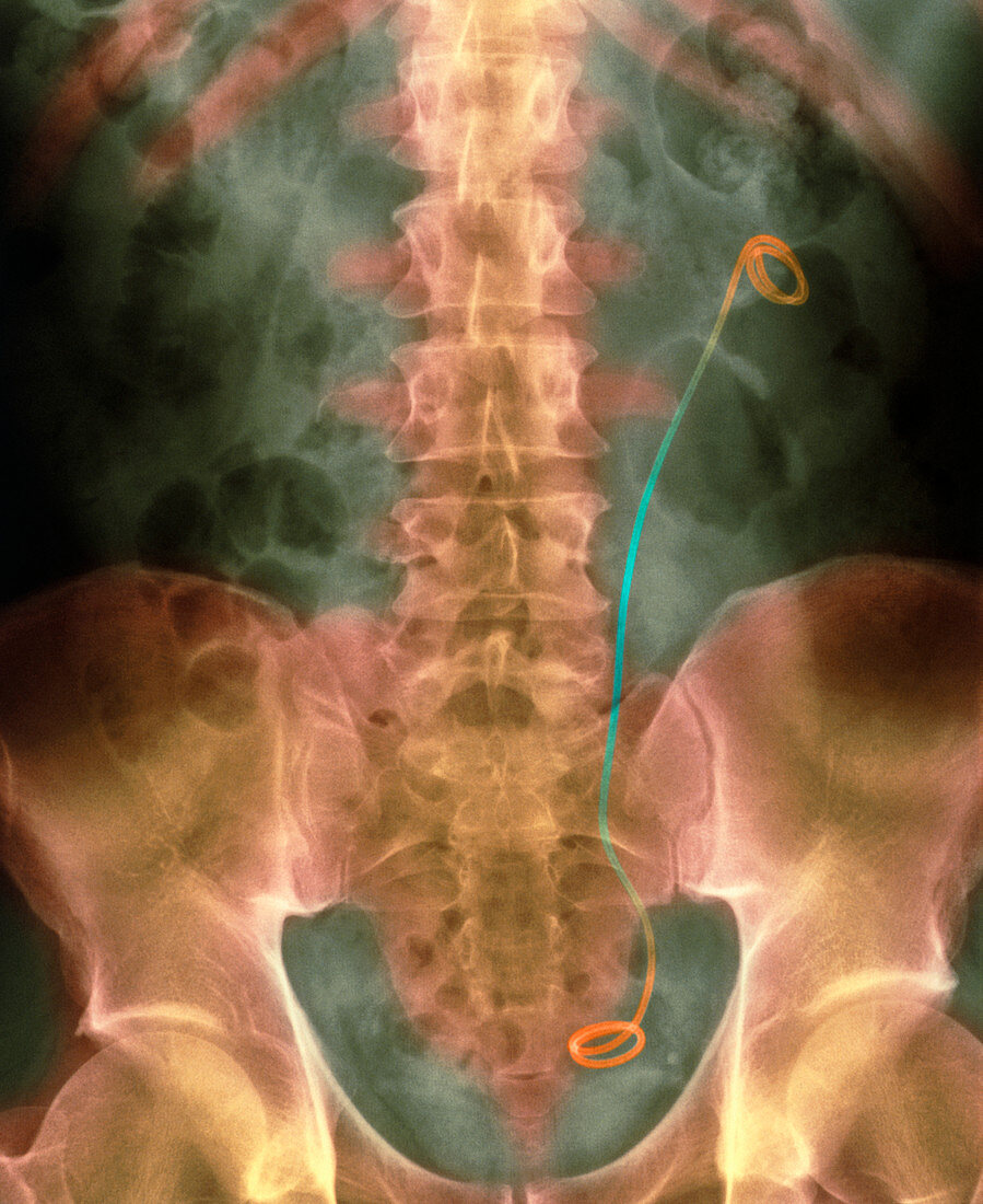 Coloured X-ray of a stent inserted in the ureter
