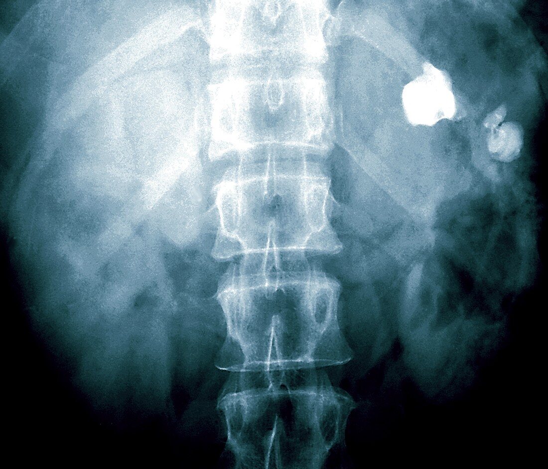 Kidney stone,X-ray