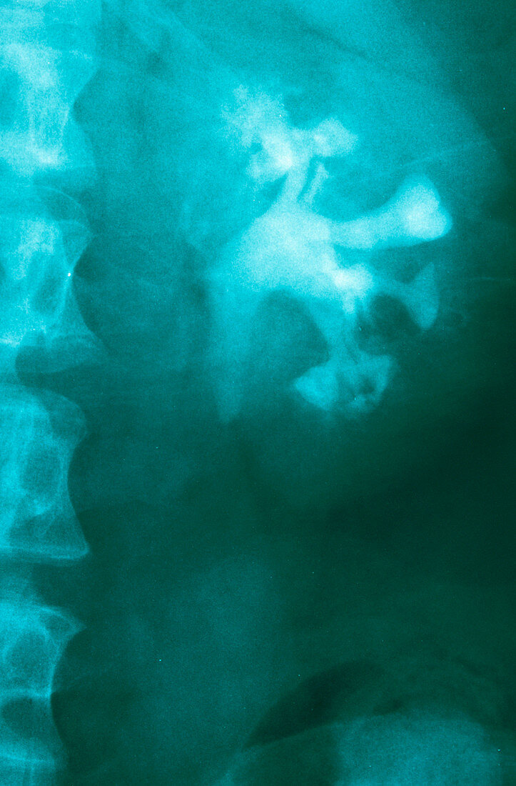 Obstructed kidney,X-ray
