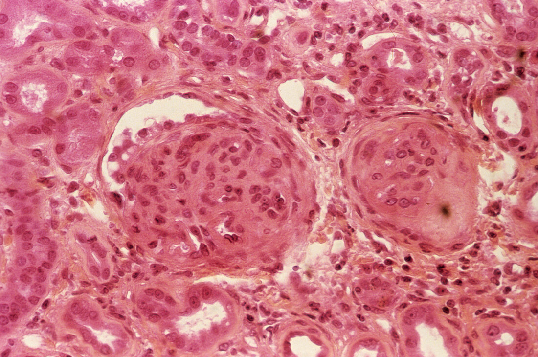 Kidney inflammation,light micrograph
