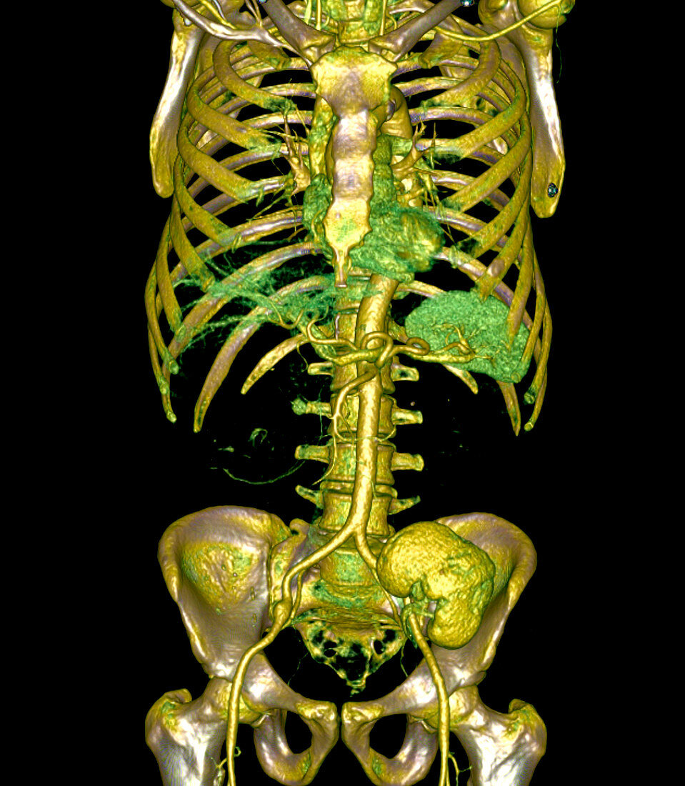 Transplanted kidney,CT scan