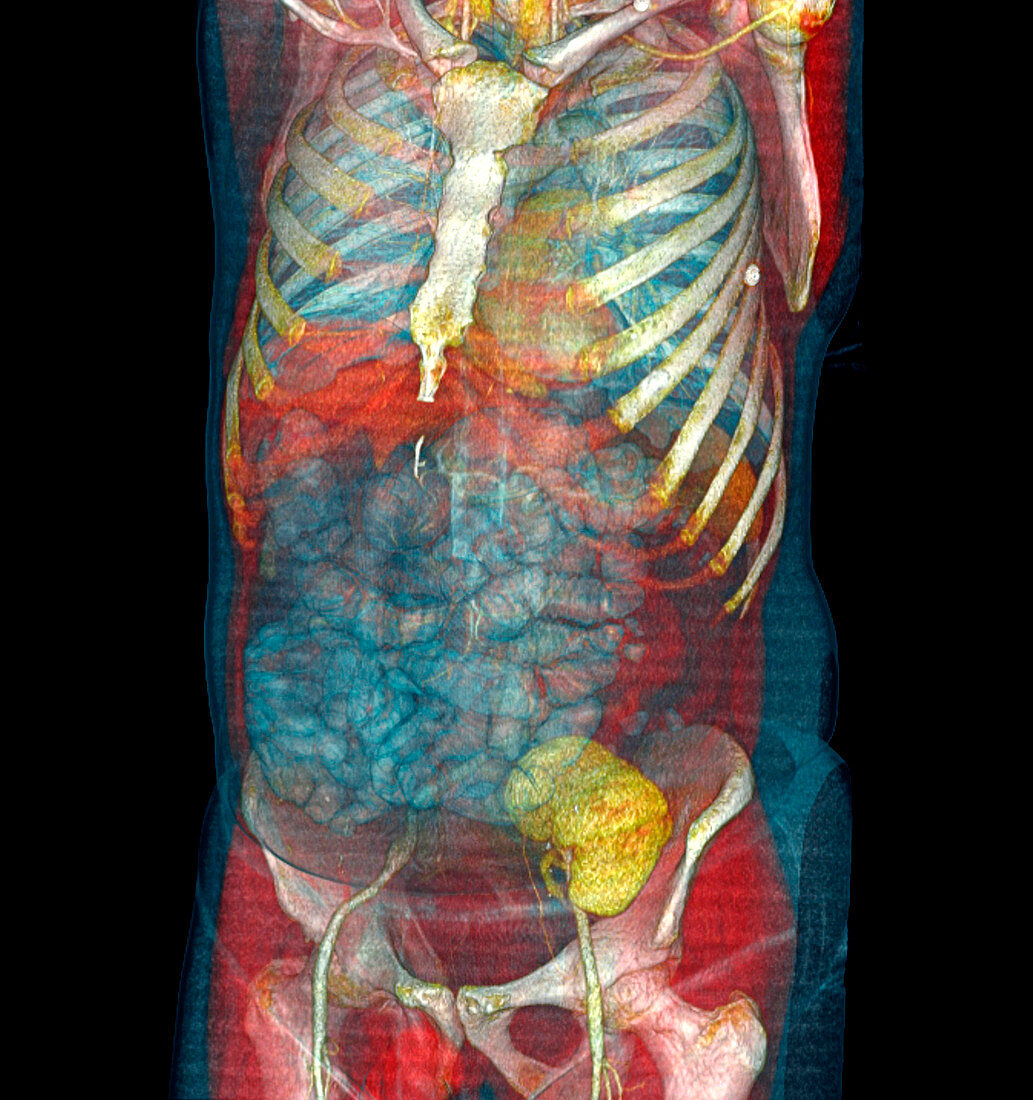 Transplanted kidney,CT scan