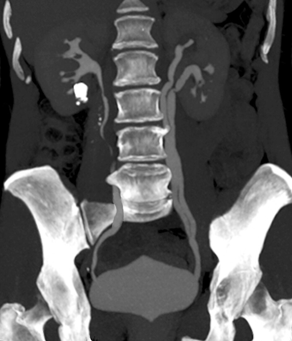 Kidney stones,CT scan