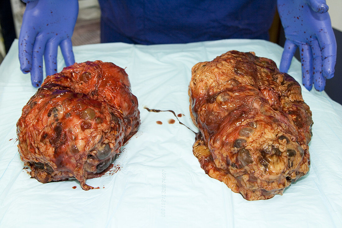 Polycystic kidneys