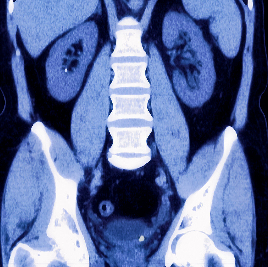 Kidney stone,MRI scan
