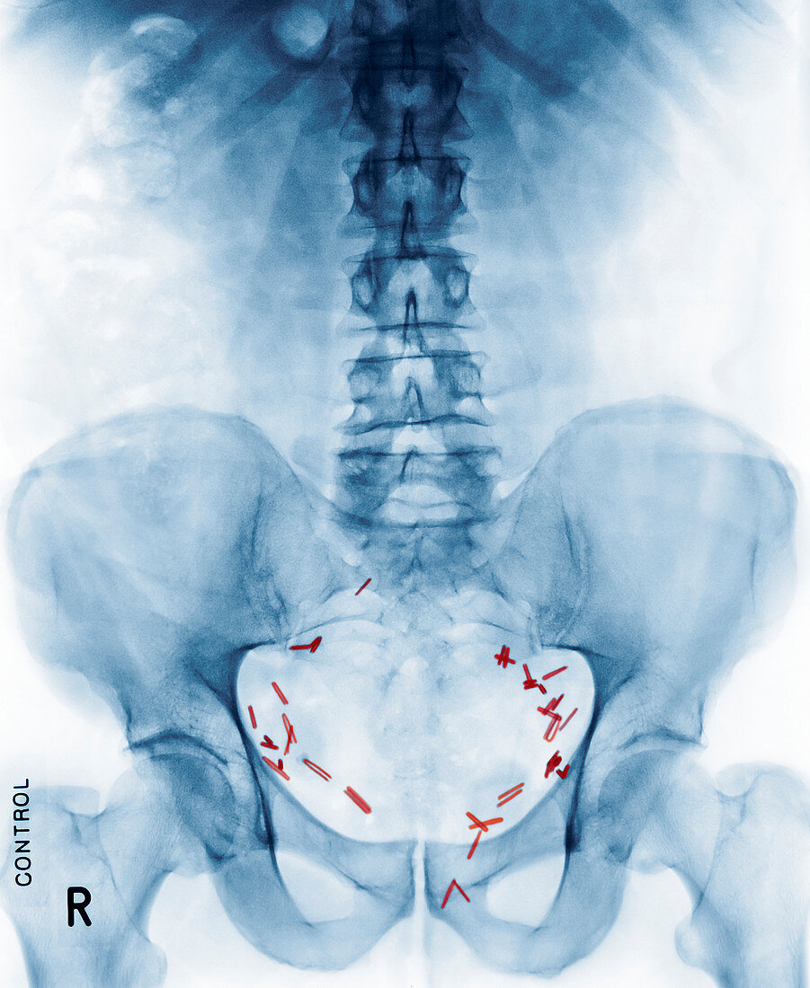Abdominal surgery,X-ray