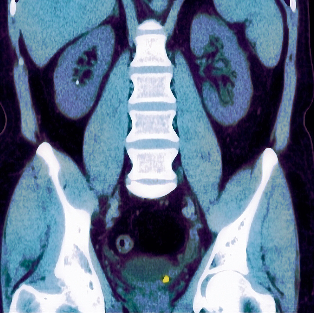 Kidney stone,MRI scan