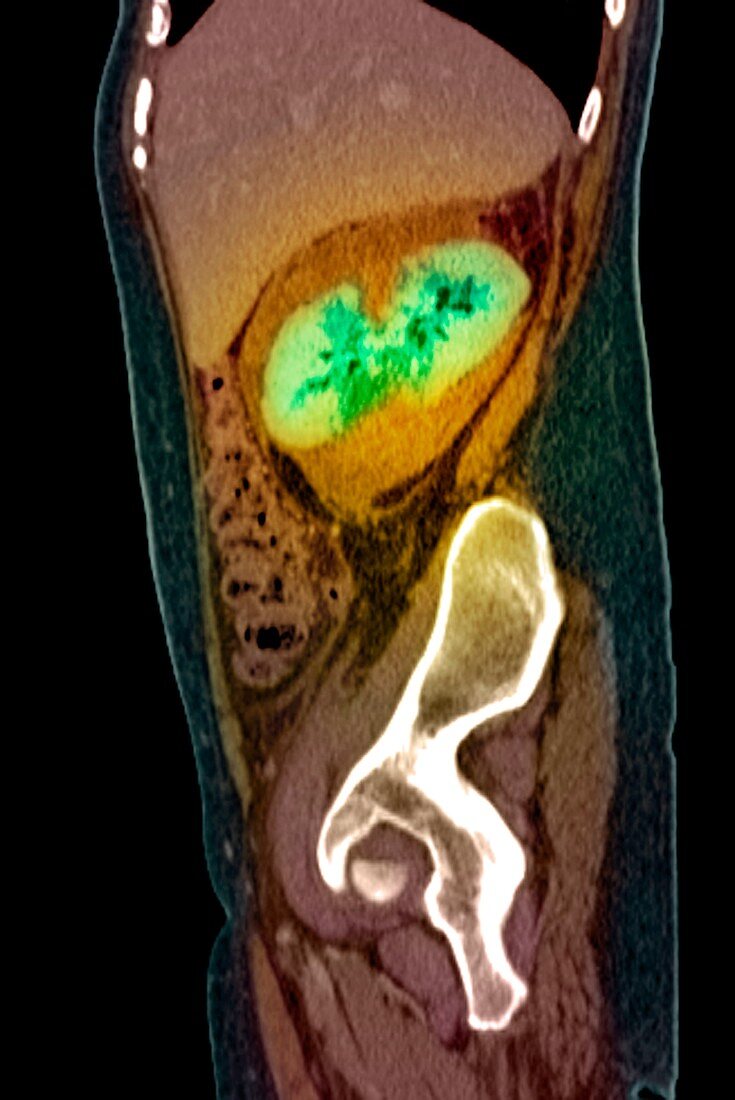 Kidney damage,CT scan