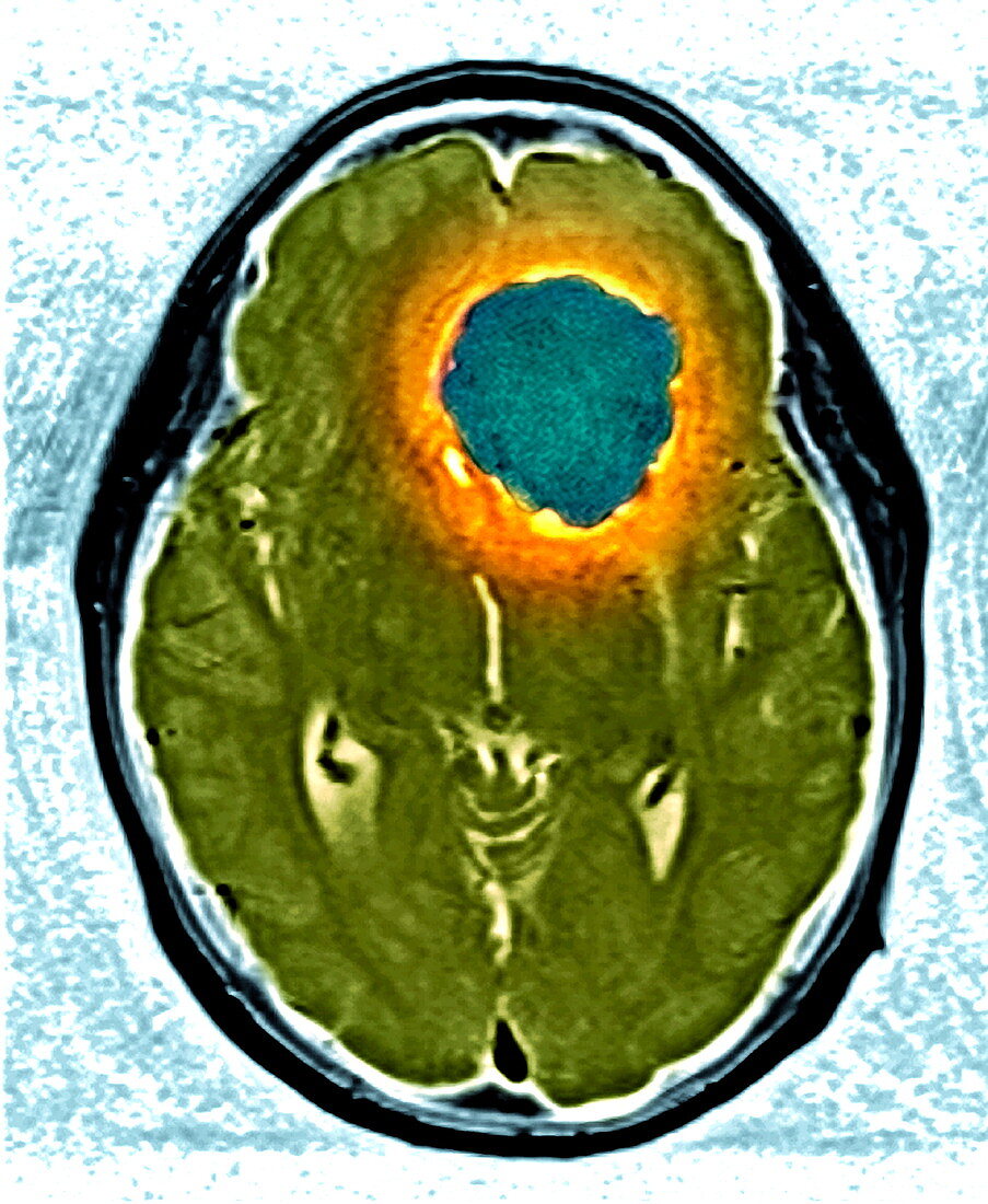 Brain tumour,MRI scan