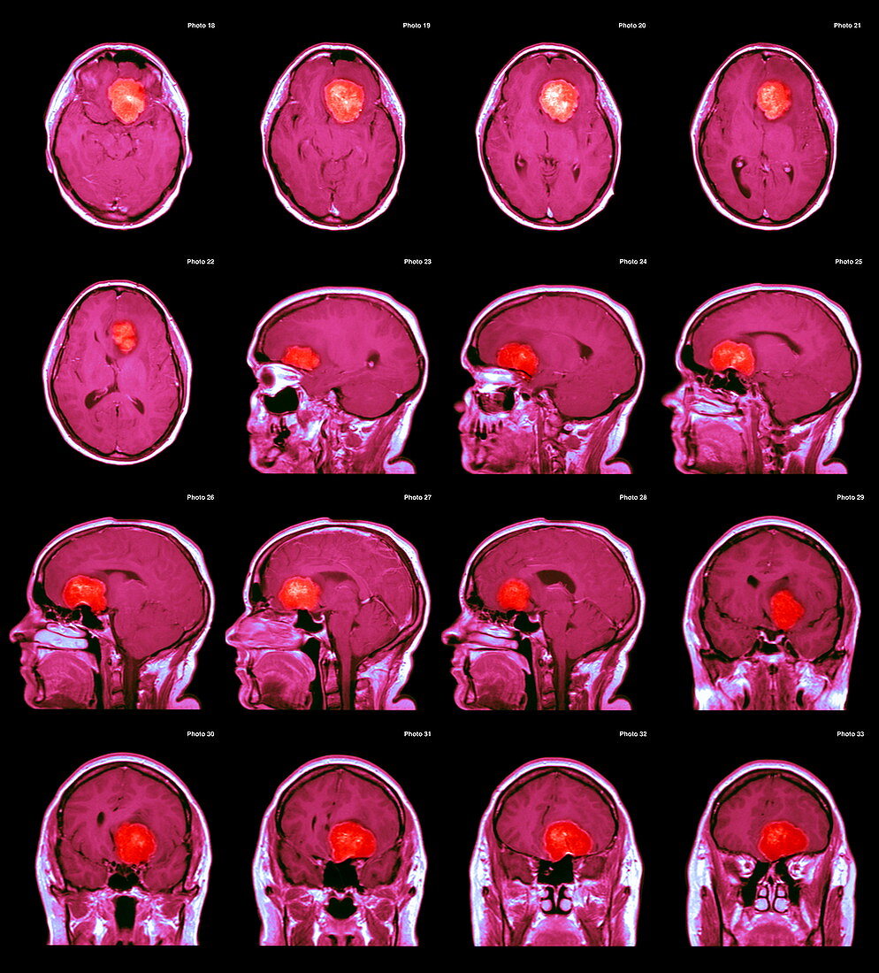 Brain tumour,MRI scans