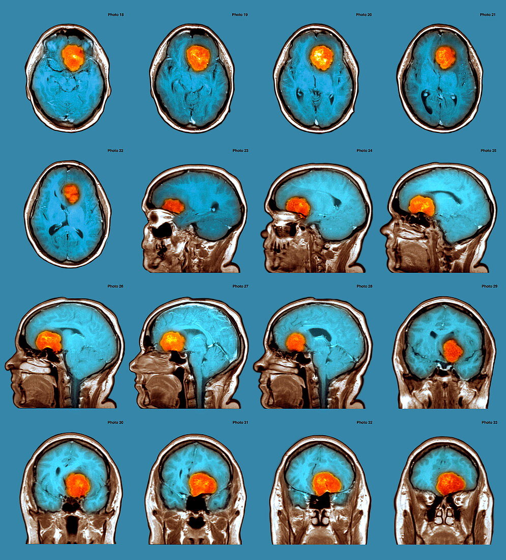 Brain tumour,MRI scans