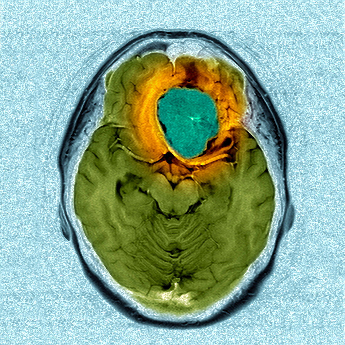 Brain tumour,MRI scan