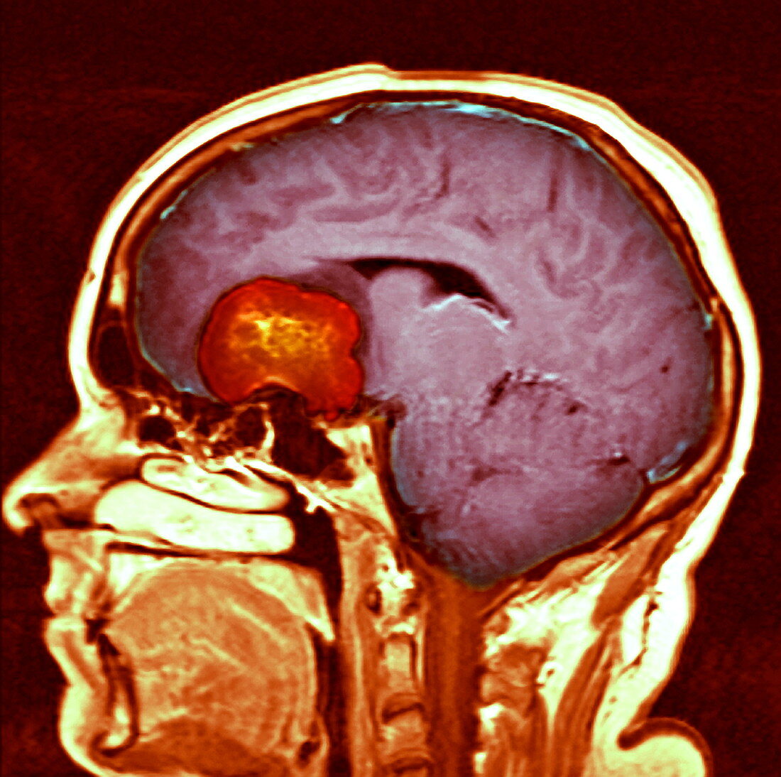 Brain tumour,MRI scan