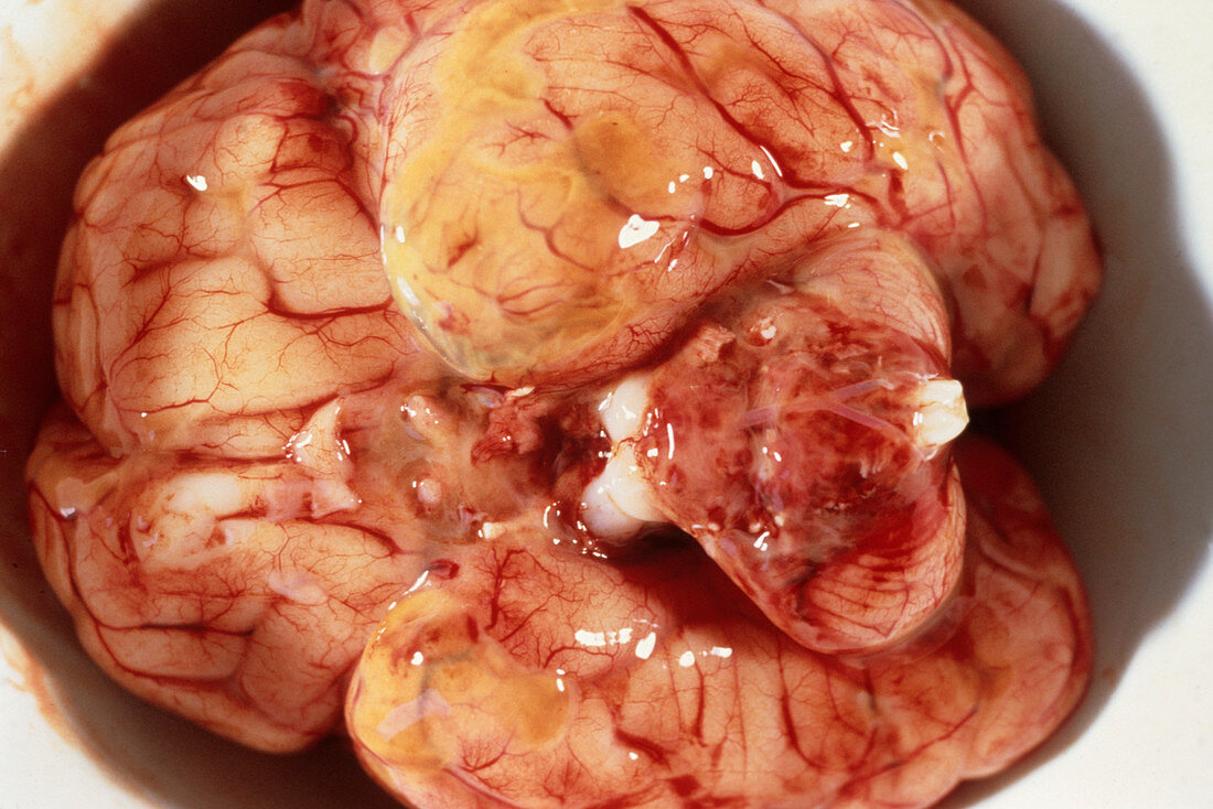 Brain with meningitis