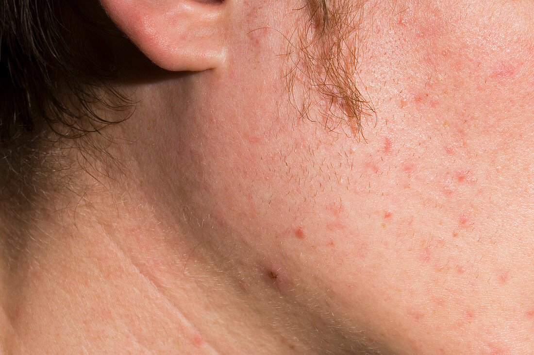 Swollen gland in mumps