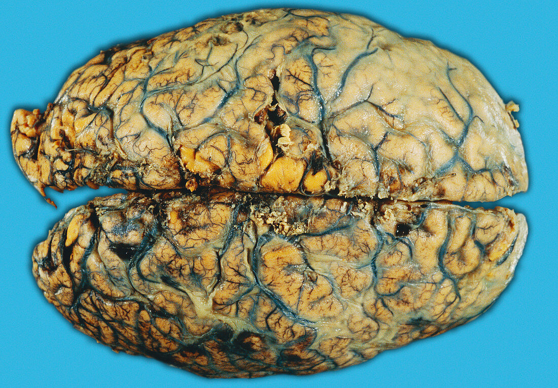 Brain with meningitis