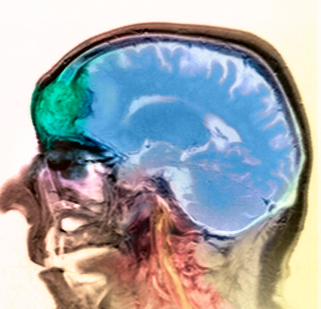 Mucocele growth,MRI scan