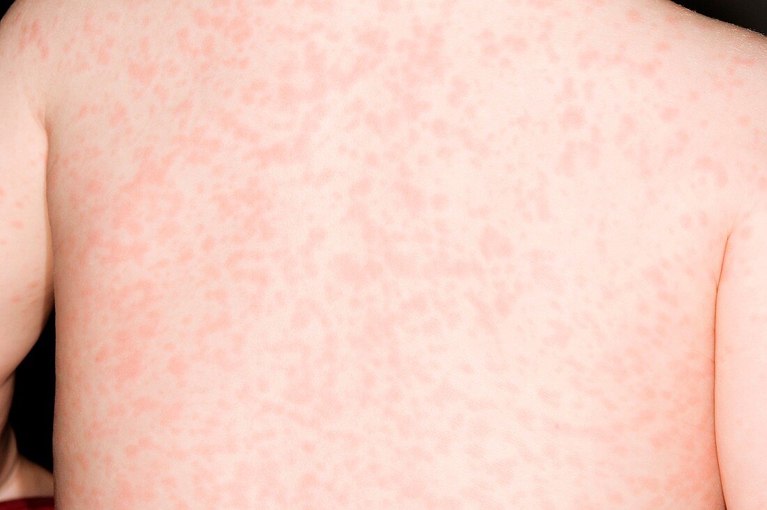 Measles rash on the back