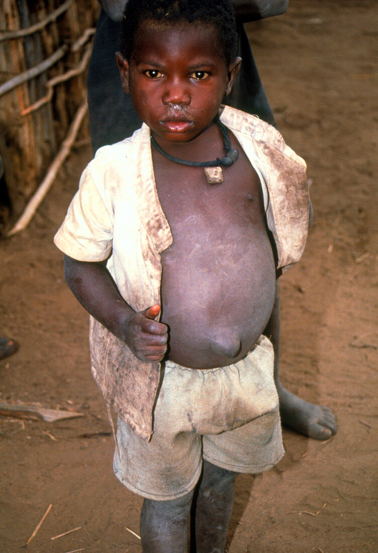 Malnourished young boy