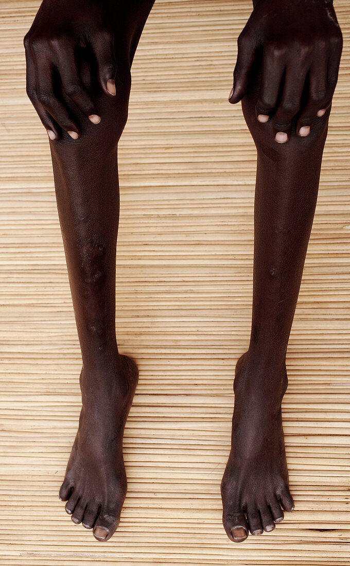 Legs of a malnourished child