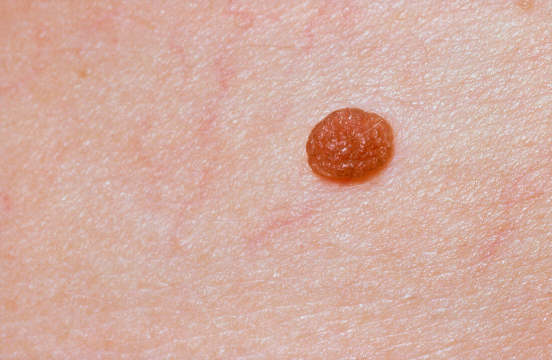 Compound naevus,a type of pigmented mole