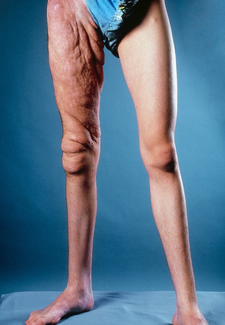 Man with neurofibromatosis affecting his thigh