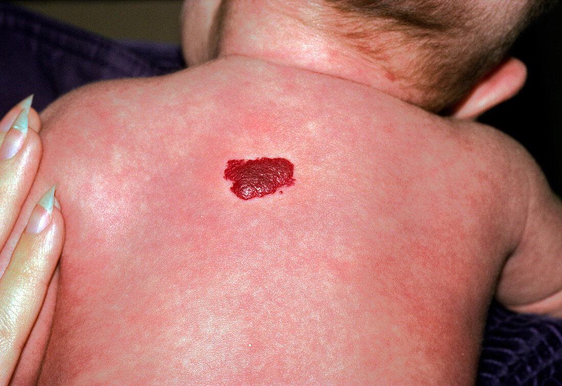 Strawberry naevus (haemangioma) on infant's back