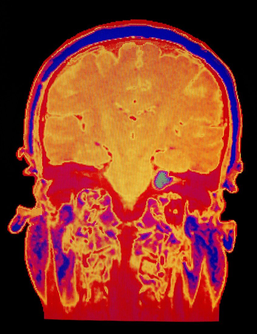 False-colour coronal MRI scan: acoustic neuroma