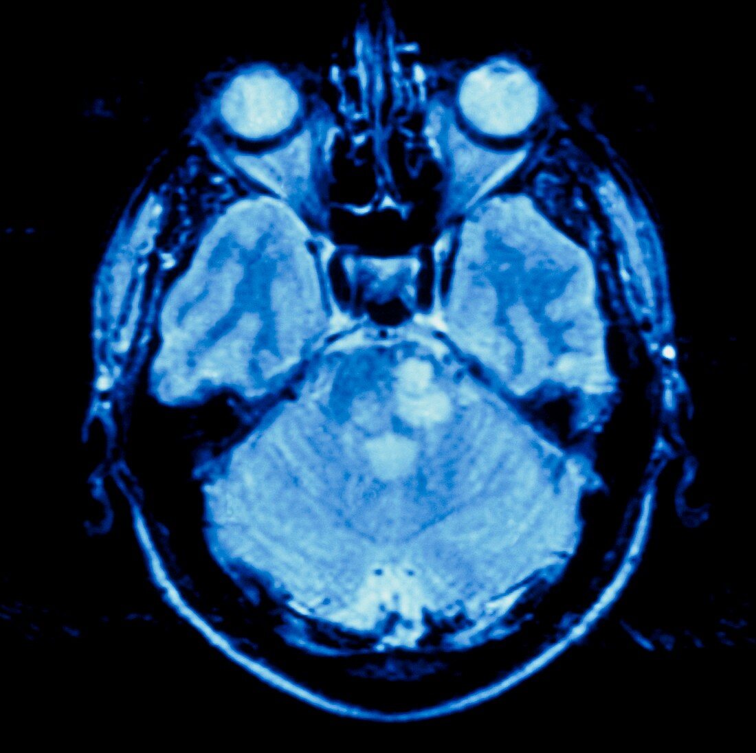 MRI scan of a brain with multiple sclerosis