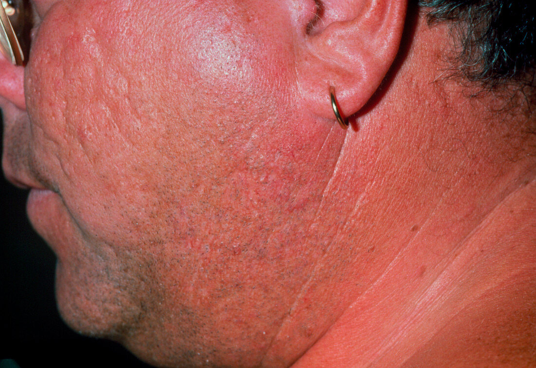 Swelling of glands in man with mumps