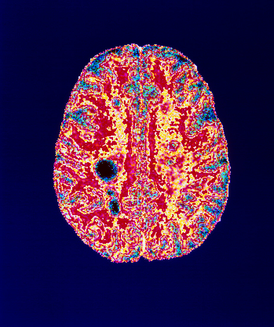 Col. MRI scan of a brain with multiple sclerosis
