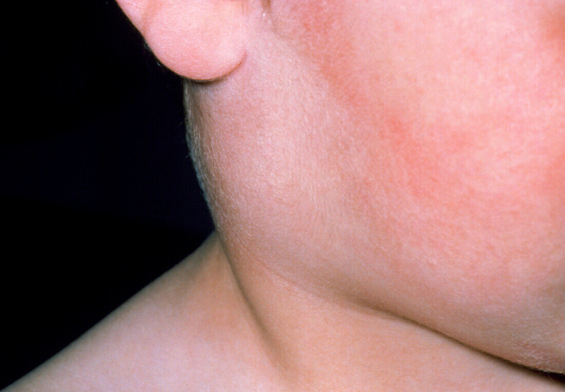 Inflamed parotid gland,child with mumps
