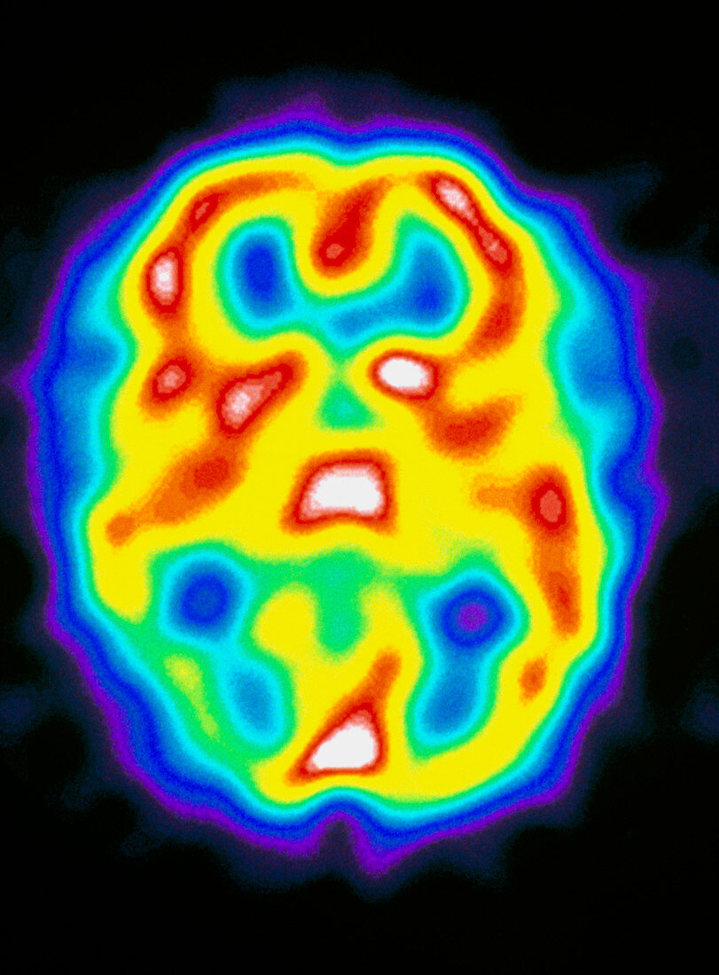 Brain during migraine,SPECT scan