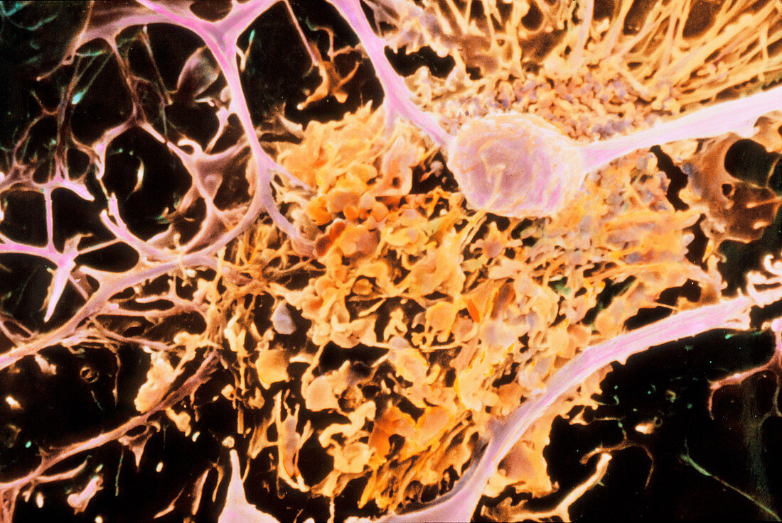 Coloured SEM of oligodendrocyte cell eaten in MS
