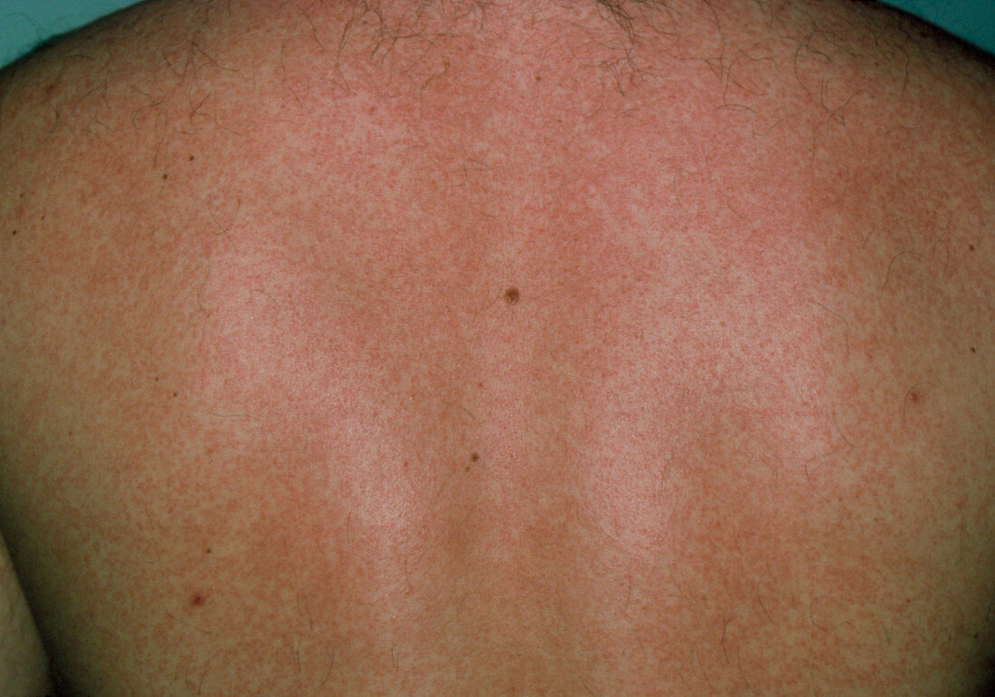 Man affected by rubella (German measles)
