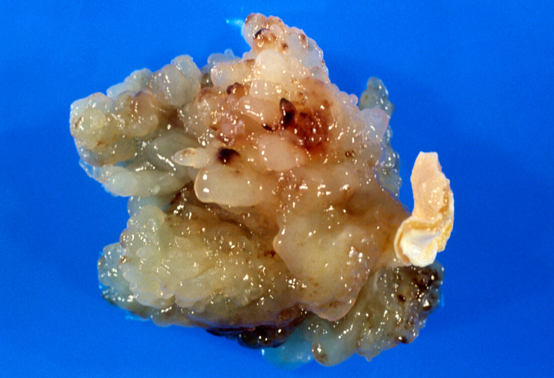 Gross specimen: atrial myxoma,benign heart tumour