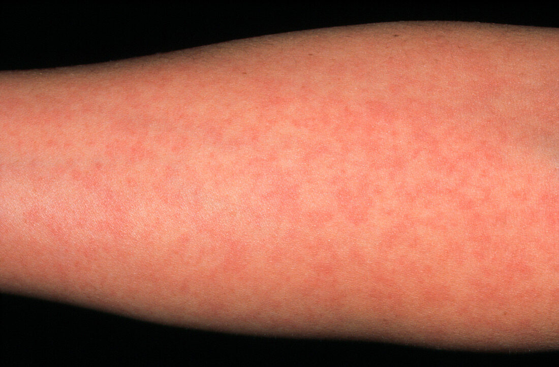 Arm of woman showing German measles rash