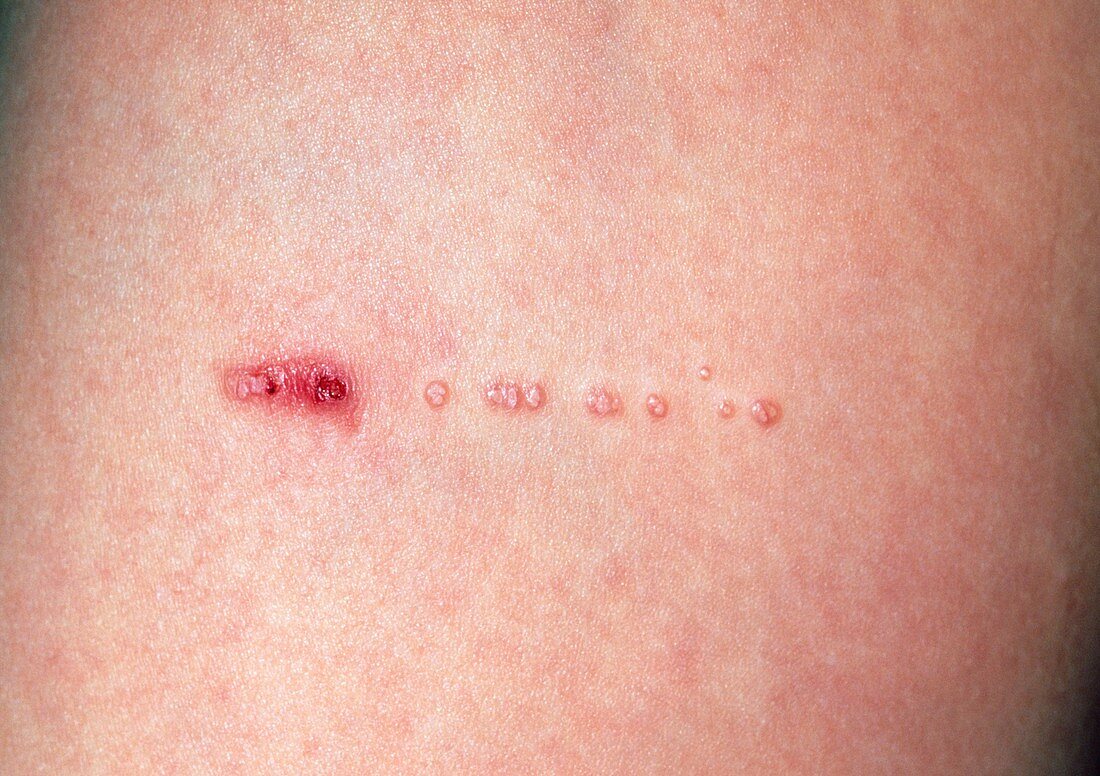 Molluscum contagiosum infection on line of scratch