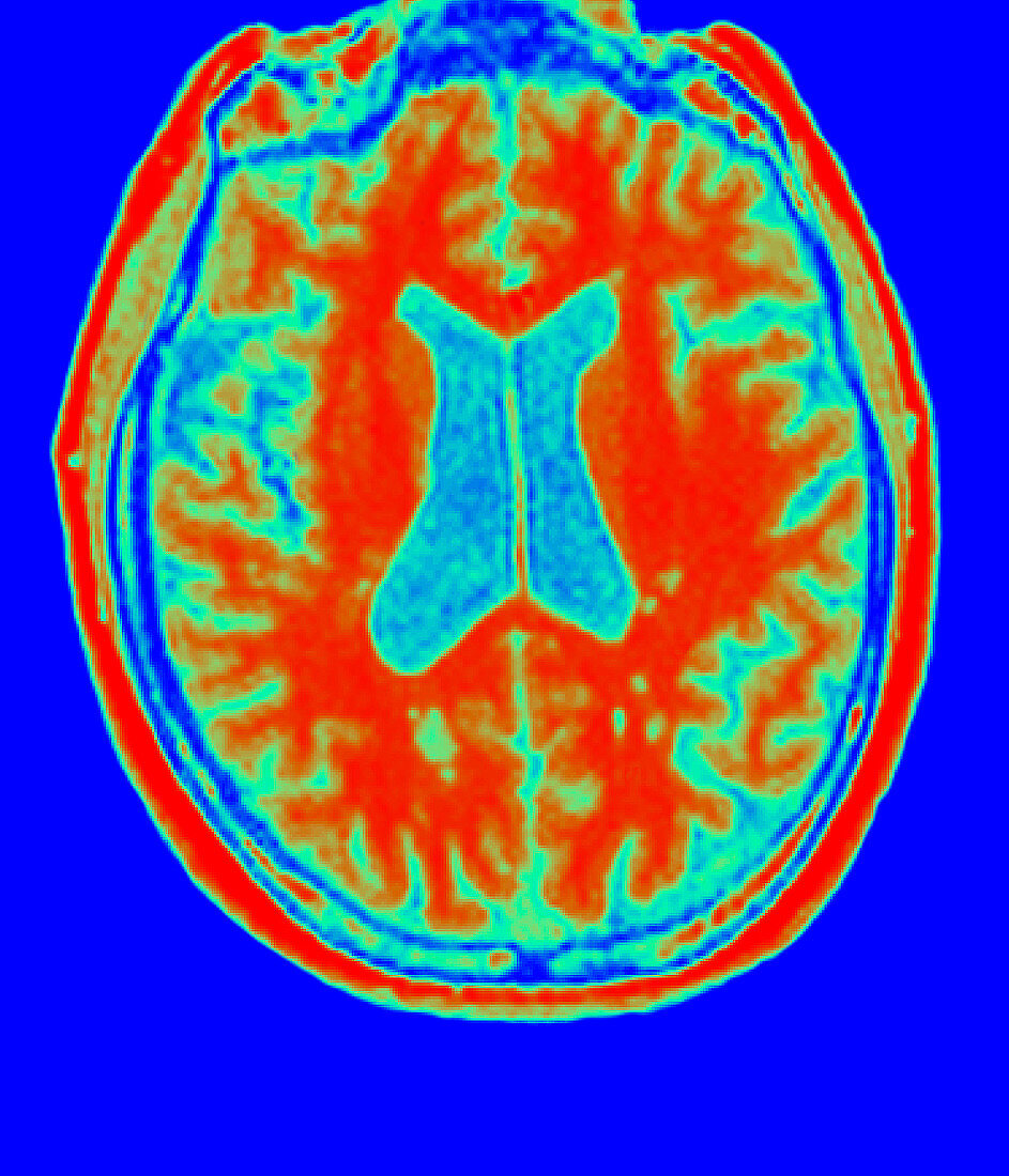 Multiple sclerosis brain MRI
