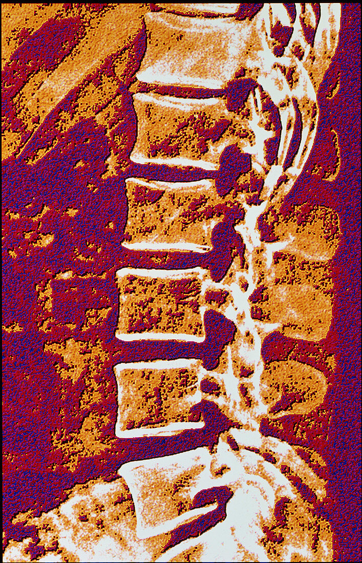 Coloured X-ray of vertebrae showing osteoporosis