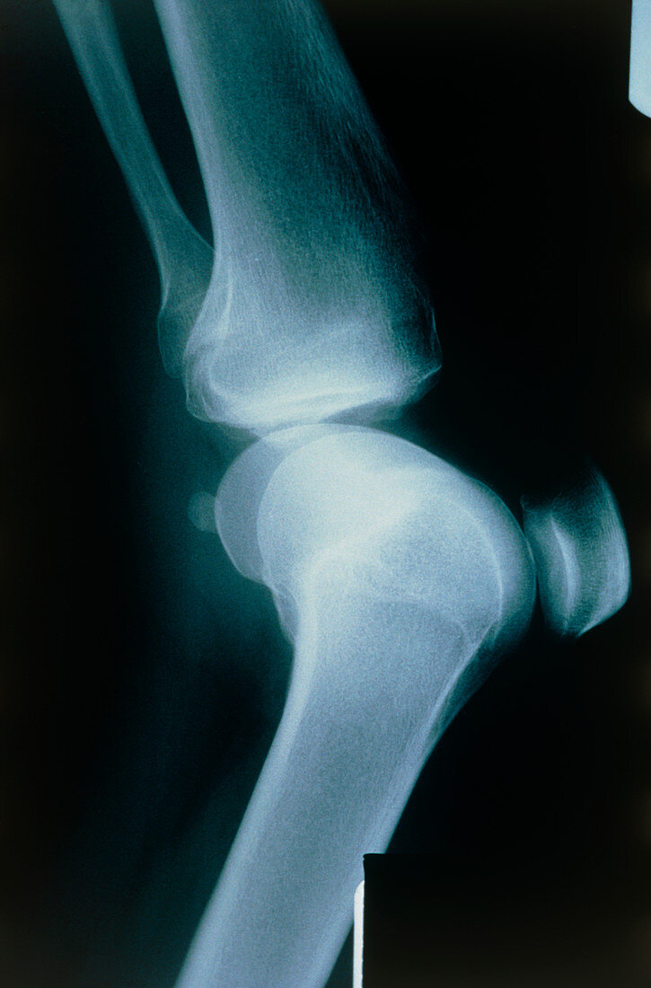 X-ray of knee showing osteochondritis dissecans