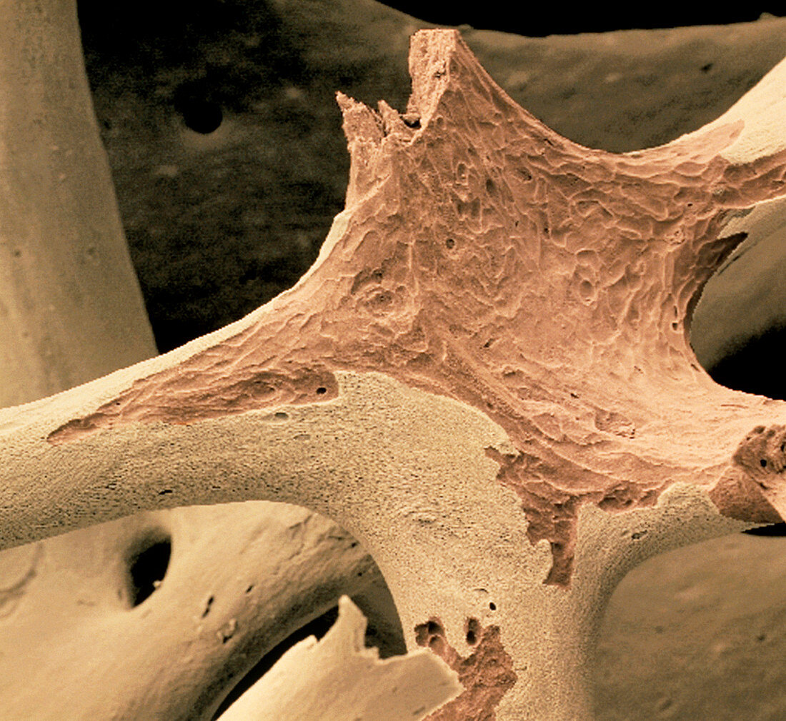 Coloured SEM of spongy bone in osteoporosis