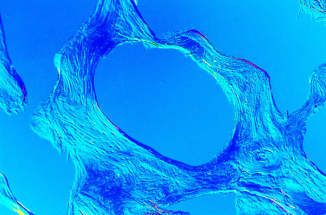 Light micrograph of compact bone with osteoporosis
