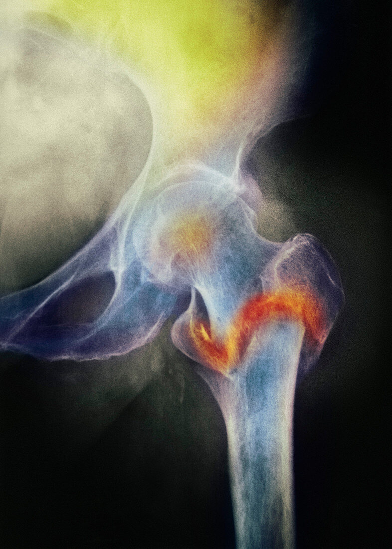 Coloured X-ray of femur fracture in osteo