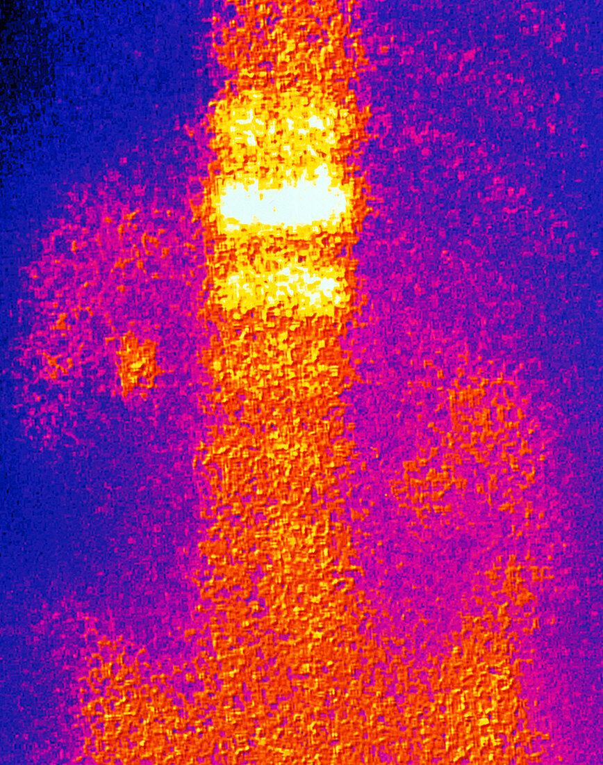 Coloured gamma scan of osteoporosis in vertebra