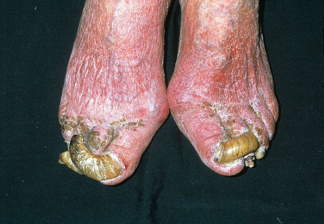 Deformed toenails