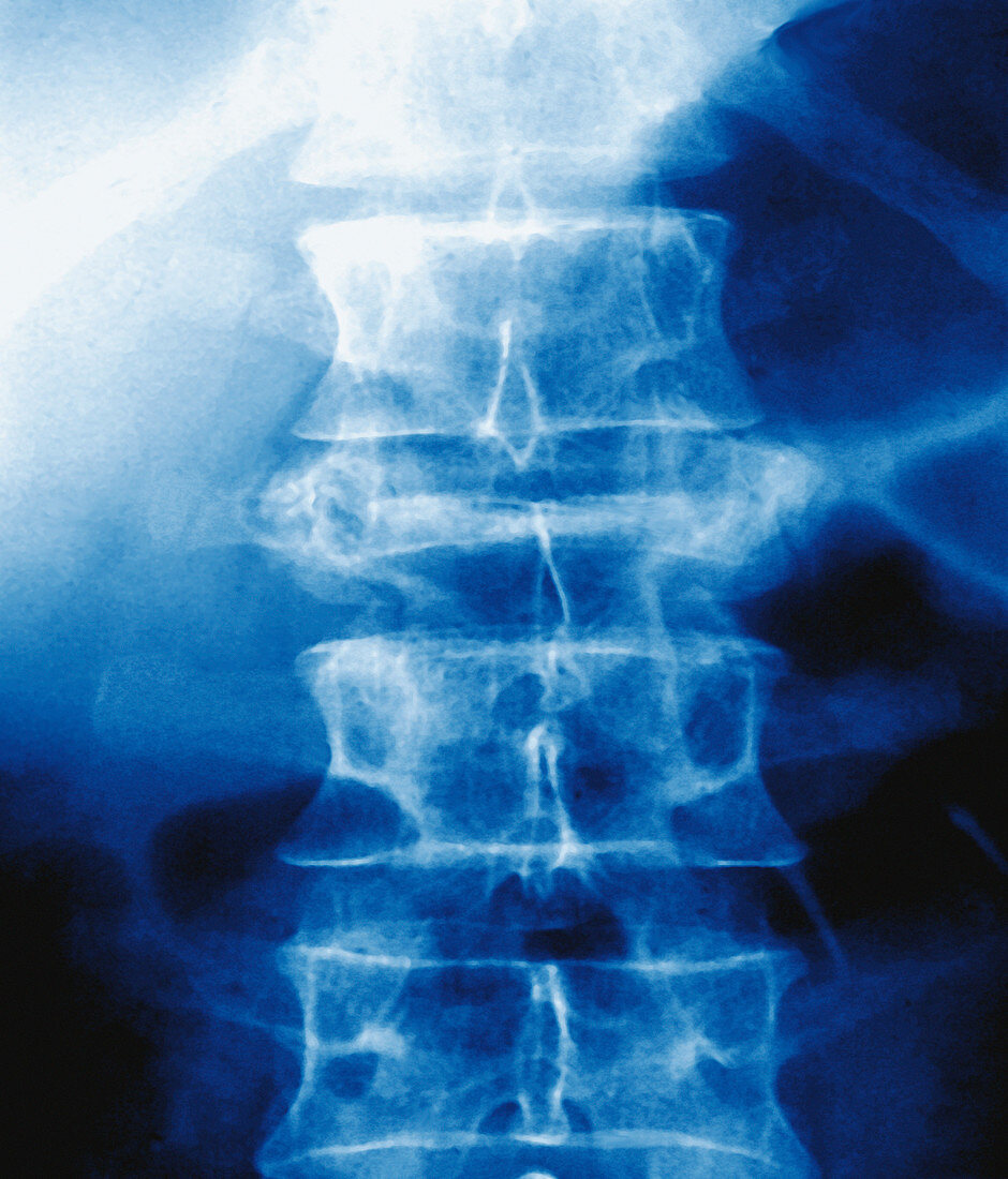 Osteoporosis of spine,X-ray